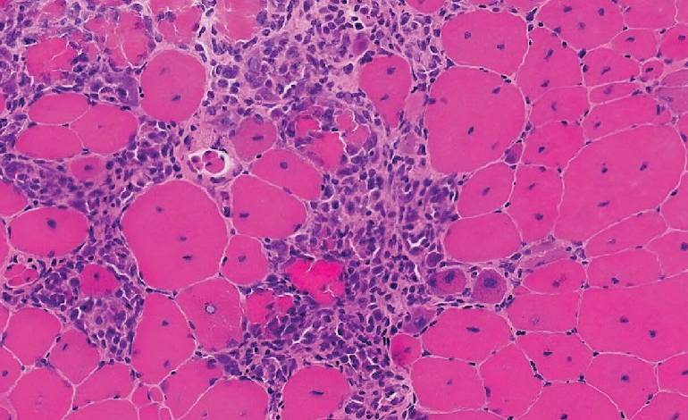 Early vamorolone treatment shows promise for toddlers with Duchenne muscular dystrophy